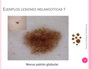 EJEMPLOS LESIONES MELANOCÍTICAS 1
18
DermatoscopiaenAtenciónPrimaria
Nevus patrón globular
 