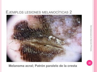 EJEMPLOS LESIONES MELANOCÍTICAS 2
20
DermatoscopiaenAtenciónPrimaria
Melanoma acral; Patrón paralelo de la cresta
 
