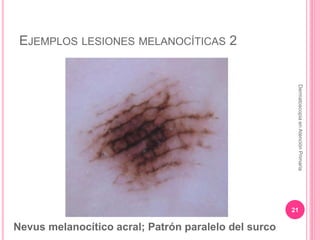 EJEMPLOS LESIONES MELANOCÍTICAS 2
21
DermatoscopiaenAtenciónPrimaria
Nevus melanocítico acral; Patrón paralelo del surco
 