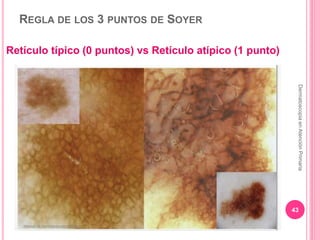 REGLA DE LOS 3 PUNTOS DE SOYER
Retículo típico (0 puntos) vs Retículo atípico (1 punto)
43
DermatoscopiaenAtenciónPrimaria
 