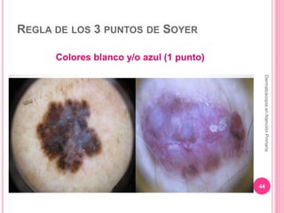 REGLA DE LOS 3 PUNTOS DE SOYER
Colores blanco y/o azul (1 punto)
44
DermatoscopiaenAtenciónPrimaria
 