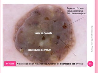DermatoscopiaenAtenciónPrimaria
63
Tapones córneos
(seudoaperturas
foliculares o criptas)
1ª etapa No criterios lesión mel...