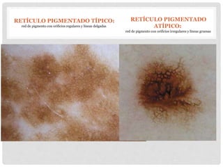 Dermatoscopia Parte1 PPTX dermatoscopia-parte1-pptx