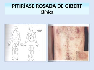 PITIRÍASE ROSADA DE GIBERT
Clínica
 