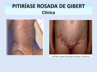 PITIRÍASE ROSADA DE GIBERT
Clínica
 