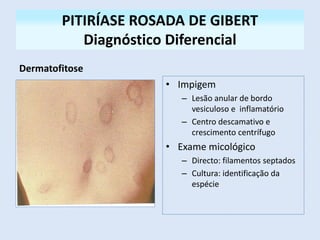 PITIRÍASE ROSADA DE GIBERT
Diagnóstico Diferencial
Dermatofitose
• Impigem
– Lesão anular de bordo
vesiculoso e inflamatório
– Centro descamativo e
crescimento centrífugo
• Exame micológico
– Directo: filamentos septados
– Cultura: identificação da
espécie
 