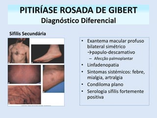 PITIRÍASE ROSADA DE GIBERT
Diagnóstico Diferencial
Sifilis Secundária
• Exantema macular profuso
bilateral simétrico
→papulo-descamativo
– Afecção palmoplantar
• Linfadenopatia
• Sintomas sistémicos: febre,
mialgia, artralgia
• Condiloma plano
• Serologia sífilis fortemente
positiva
 