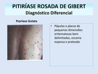 PITIRÍASE ROSADA DE GIBERT
Diagnóstico Diferencial
Psoríase Gutata
• Pápulas e placas de
pequenas dimensões
eritematosas bem
delimitadas, escama
espessa e prateada
 