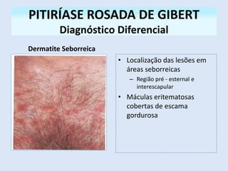 PITIRÍASE ROSADA DE GIBERT
Diagnóstico Diferencial
Dermatite Seborreica
• Localização das lesões em
áreas seborreicas
– Região pré - esternal e
interescapular
• Máculas eritematosas
cobertas de escama
gordurosa
 
