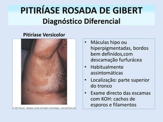 PITIRÍASE ROSADA DE GIBERT
Diagnóstico Diferencial
Pitiríase Versicolor
• Máculas hipo ou
hiperpigmentadas, bordos
bem definidos,com
descamação furfurácea
• Habitualmente
assintomáticas
• Localização: parte superior
do tronco
• Exame directo das escamas
com KOH: cachos de
esporos e filamentos
 