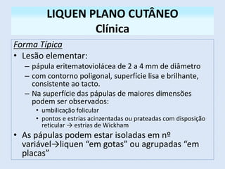 LIQUEN PLANO CUTÂNEO
Clínica
Forma Típica
• Lesão elementar:
– pápula eritematoviolácea de 2 a 4 mm de diâmetro
– com contorno poligonal, superfície lisa e brilhante,
consistente ao tacto.
– Na superfície das pápulas de maiores dimensões
podem ser observados:
• umbilicação folicular
• pontos e estrias acinzentadas ou prateadas com disposição
reticular → estrias de Wickham
• As pápulas podem estar isoladas em nº
variável→liquen “em gotas” ou agrupadas “em
placas”
 
