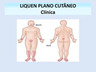 LIQUEN PLANO CUTÂNEO
Clínica
 