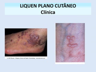 LIQUEN PLANO CUTÂNEO
Clínica
 