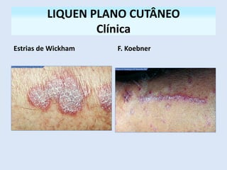 LIQUEN PLANO CUTÂNEO
Clínica
Estrias de Wickham F. Koebner
 
