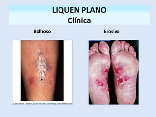 LIQUEN PLANO
Clínica
Bolhoso Erosivo
 