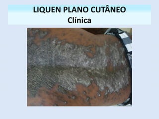 LIQUEN PLANO CUTÂNEO
Clínica
 