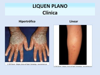 LIQUEN PLANO
Clínica
Hipertrófico Linear
 