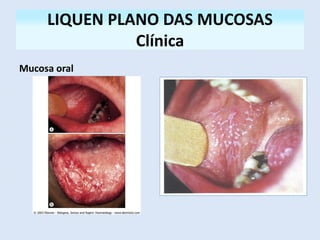 LIQUEN PLANO DAS MUCOSAS
Clínica
Mucosa oral
 