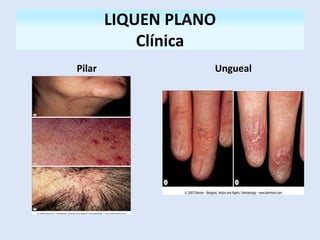 Pilar Ungueal
LIQUEN PLANO
Clínica
 