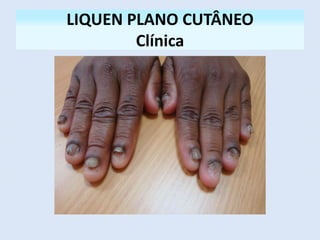 LIQUEN PLANO CUTÂNEO
Clínica
 