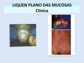 LIQUEN PLANO DAS MUCOSAS
Clínica
 