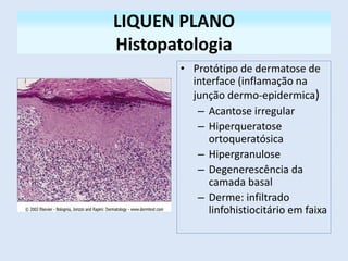 LIQUEN PLANO
Histopatologia
• Protótipo de dermatose de
interface (inflamação na
junção dermo-epidermica)
– Acantose irregular
– Hiperqueratose
ortoqueratósica
– Hipergranulose
– Degenerescência da
camada basal
– Derme: infiltrado
linfohistiocitário em faixa
 