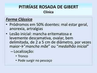 PITIRÍASE ROSADA DE GIBERT
Clínica
Forma Clássica
• Pródromos em 50% doentes: mal estar geral,
anorexia, artralgias
• Lesão inicial: mancha eritematosa e
levemente descamativa, ovalar, bem
delimitada, de 2 a 5 cm de diâmetro, por vezes
maior→”mancha mãe” ou “medalhão inicial”
– Localização:
• Tronco
• Pode surgir no pescoço
 