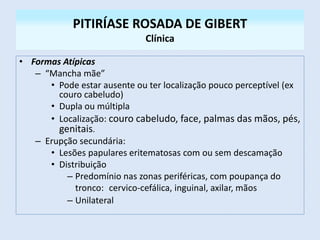PITIRÍASE ROSADA DE GIBERT
Clínica
• Formas Atípicas
– “Mancha mãe”
• Pode estar ausente ou ter localização pouco perceptível (ex
couro cabeludo)
• Dupla ou múltipla
• Localização: couro cabeludo, face, palmas das mãos, pés,
genitais.
– Erupção secundária:
• Lesões papulares eritematosas com ou sem descamação
• Distribuição
– Predomínio nas zonas periféricas, com poupança do
tronco: cervico-cefálica, inguinal, axilar, mãos
– Unilateral
 