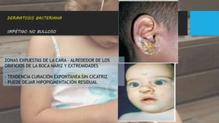 IMPÉTIGO NO BULLOSO
DERMATOSIS BACTERIANA
ZONAS EXPUESTAS DE LA CARA – ALREDEDOR DE LOS
ORIFICIOS DE LA BOCA NARIZ Y EXTREMIDADES
- TENDENCIA CURACIÓN EXPONTANEA SIN CICATRIZ
- PUEDE DEJAR HIPOPIGMENTACIÓN RESIDUAL
 