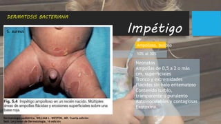 Dermatología pediátrica. WILLIAM L. WESTON, MD. Cuarta edición
Saúl. Lecciones de Dermatología. 16 edición
DERMATOSIS BACTERIANA
Impétigo
Contagioso, No ampolloso, Vulgar Ampolloso, bulloso
70% a 80% 10% al 30%
Neonatos
Ampollas de 0,5 a 2 o más
cm, superficiales
Tronco y extremidades
Flácidas sin halo eritematoso
Contenido turbio,
transparente o purulento
Autoinoculables y contagiosas
Exotoxina.
S. aureus
 