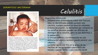Celulitis
DERMATOSIS BACTERIANA
Diagnóstico diferencial
- Inflamaciones eritematosas sobre una fractura
ósea no identificada pueden parecer una
celulitis, aunque pueden no sentirse calientes.
- Eritema de presión, la dermatitis por contacto en
los estadios iniciales pueden ser difíciles de
distinguir de la celulitis, pero no son dolorosos a
la palpación.
- El enrojecimiento y la inflamación en una
articulación séptica también puede parecer una
celulitis.
- La lesión aguda por frío en la grasa de las
mejillas de los lactantes («paniculitis del
helado») puede imitar a una celulitis facial
 