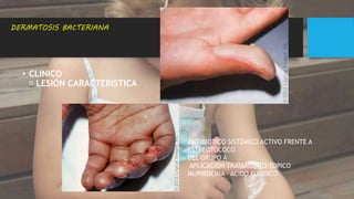 • CLINICO
LESIÓN CARACTERISTICA
DERMATOSIS BACTERIANA
ANTIBIOTICO SISTÉMICO ACTIVO FRENTE A
ESTREOTOCOCO
DEL GRUPO A
APLICACIÓN TRATAMIENTO TOPICO
MUPIROCINA – ACIDO FUSIDICO
 