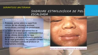SINDROME ESTAFILOCÓCICA DE PIEL
ESCALDADA
• TOXINA EXFOLIATIVA S. AUREUS
• Proteasa, actúa sobre la superficie
celular de las células granulosas
epidérmicas y activa a las proteinasas
• La lesión de estos queratinocitos se
traduce en la separación intraepidérmica
de las células dentro de la capa
granulosa y el desprendimiento posterior
de la capa granulosa y del estrato córneo
en su totalidad cuando se produce un
traumatismo mínimo
•
DERMATOSIS BACTERIANA
 