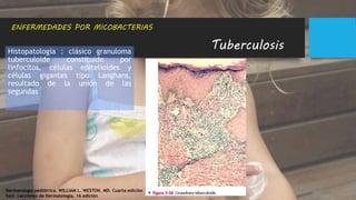 Tuberculosis
ENFERMEDADES POR MICOBACTERIAS
Histopatología : clásico granuloma
tuberculoide constituido por
linfocitos, células epitelioides y
células gigantes tipo Langhans,
resultado de la unión de las
segundas
Dermatología pediátrica. WILLIAM L. WESTON, MD. Cuarta edición
Saúl. Lecciones de Dermatología. 16 edición
 