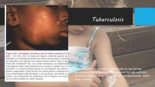 Tuberculosis
ENFERMEDADES POR MICOBACTERIAS
En la tuberculosis cutánea se
emplean los mismos fármacos que
en la tuberculosis en general y a
dosis semejantes.
1) rifampicina, que interfiere con la
formulación del ácido ribonucleico
(RNA) e impide la du- plicación
celular; 2) isoniacida, que bloquea
la formación de la membrana celular
del bacilo, y 3) pirazinamida, que
Interfiere en el transporte de
oxígeno Este tratamiento se aplica sobre todo en las formas
pulmonares de la tuberculosis, pero no ha sido suficien-
temente probado en la tuberculosis extrapulmonar, sobre
todo cutánea.
 