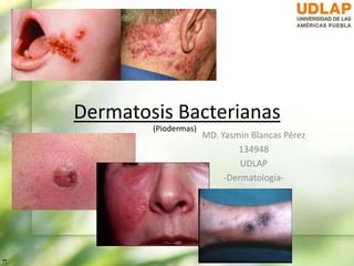 Dermatosis Bacterianas
MD. Yasmin Blancas Pérez
134948
UDLAP
-Dermatología-
(Piodermas)
 
