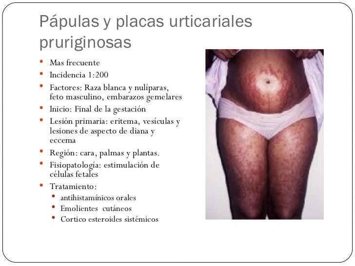 Las derrotas de la piel a la psoriasis