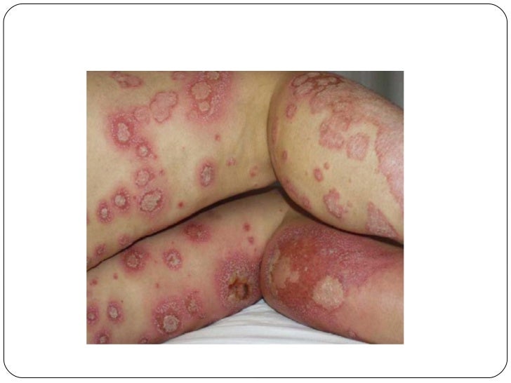 Si es posible dar la sangre a la donación de sangre a la psoriasis