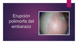 Erupción
polimorfa del
embarazo
 