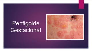 Penfigoide
Gestacional
 