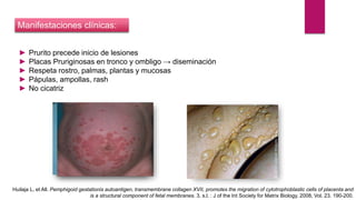 ► Prurito precede inicio de lesiones
► Placas Pruriginosas en tronco y ombligo → diseminación
► Respeta rostro, palmas, plantas y mucosas
► Pápulas, ampollas, rash
► No cicatriz
Manifestaciones clínicas:
Huilaja L, et All. Pemphigoid gestationis autoantigen, transmembrane collagen XVII, promotes the migration of cytotrophoblastic cells of placenta and
is a structural component of fetal membranes. 3, s.l. : J of the Int Society for Matrix Biology, 2008, Vol. 23. 190-200.
 