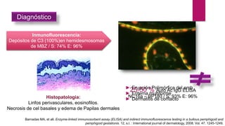 25-50 % Auto Ac IgG ELISA
NC16a – BP180 / S: 93% E: 96%
Diagnóstico
► Erupción Polimórfica del emb
► Eritema multiforme
► Dermatitis de contacto
Inmunofluorescencia:
Depósitos de C3 (100%)en hemidesmosomas
de MBZ / S: 74% E: 96%
Histopatologia:
Linfos perivasculares, eosinofilos.
Necrosis de cel basales y edema de Papilas dermales
Barnadas MA, et all. Enzyme-linked immunosorbent assay (ELISA) and indirect immunofluorescence testing in a bullous pemphigoid and
pemphigoid gestationis. 12, s.l. : International journal of dermatology, 2008, Vol. 47. 1245-1249.
 