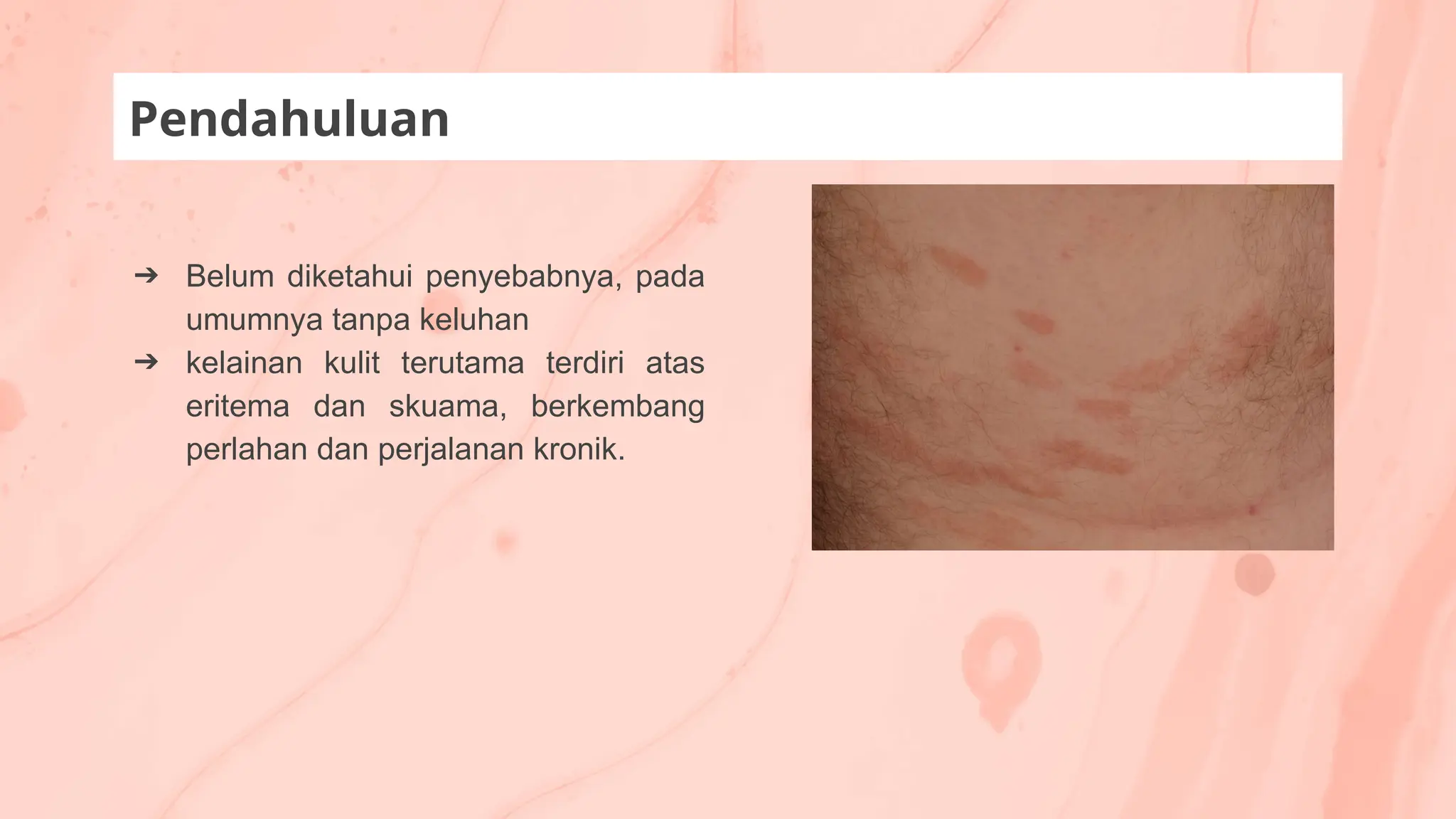 ➔ Belum diketahui penyebabnya, pada
umumnya tanpa keluhan
➔ kelainan kulit terutama terdiri atas
eritema dan skuama, berkembang
perlahan dan perjalanan kronik.
Pendahuluan
 