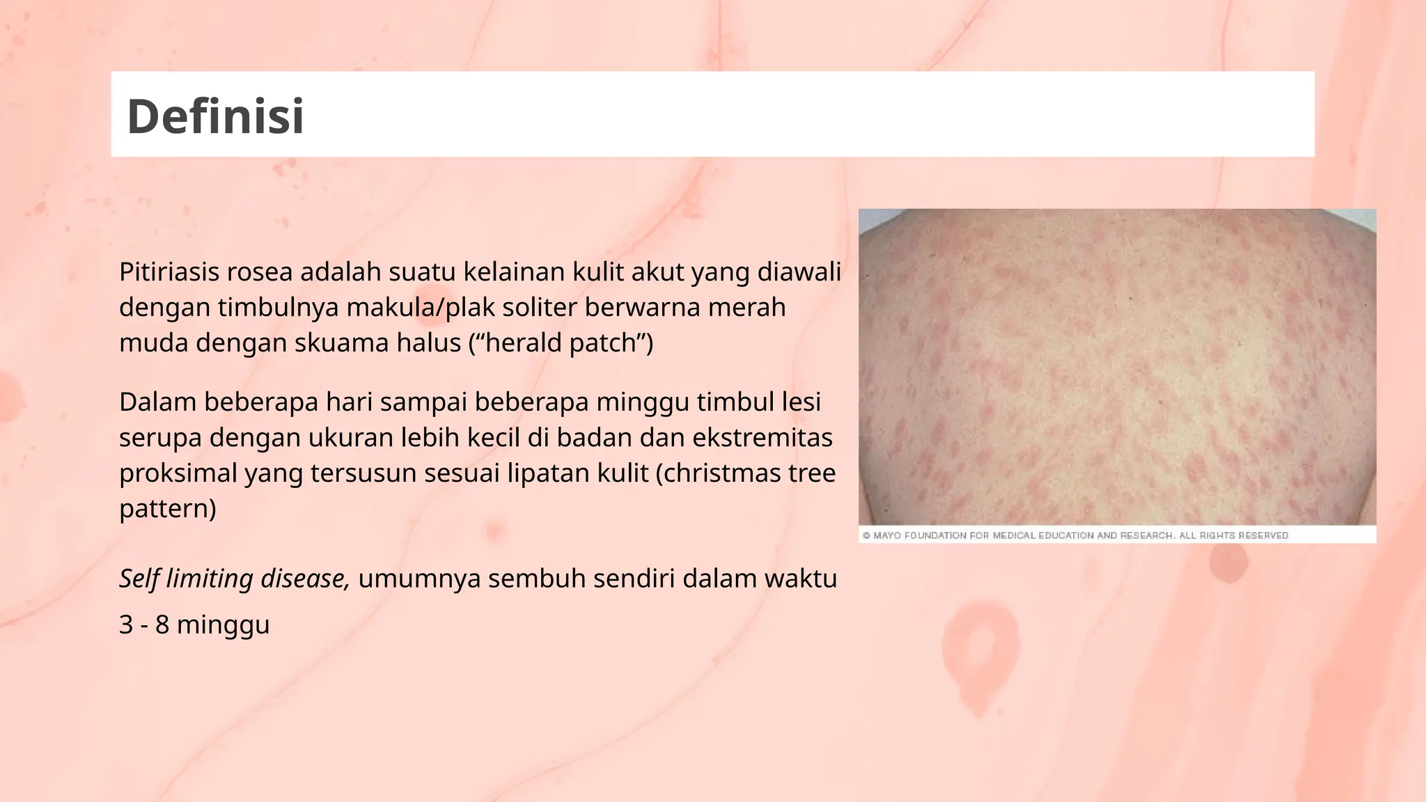 Pitiriasis rosea adalah suatu kelainan kulit akut yang diawali
dengan timbulnya makula/plak soliter berwarna merah
muda dengan skuama halus (“herald patch”)
Dalam beberapa hari sampai beberapa minggu timbul lesi
serupa dengan ukuran lebih kecil di badan dan ekstremitas
proksimal yang tersusun sesuai lipatan kulit (christmas tree
pattern)
Self limiting disease, umumnya sembuh sendiri dalam waktu
3 - 8 minggu
Definisi
 