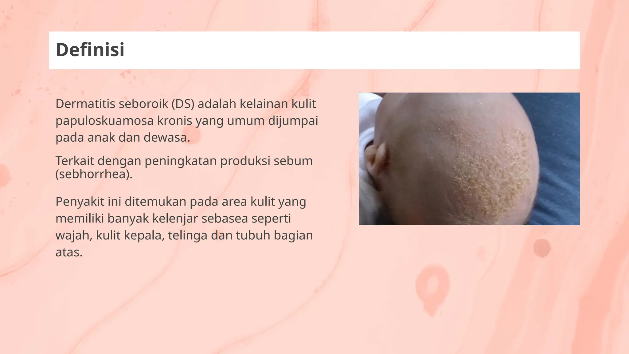 Dermatitis seboroik (DS) adalah kelainan kulit
papuloskuamosa kronis yang umum dijumpai
pada anak dan dewasa.
Terkait dengan peningkatan produksi sebum
(sebhorrhea).
Penyakit ini ditemukan pada area kulit yang
memiliki banyak kelenjar sebasea seperti
wajah, kulit kepala, telinga dan tubuh bagian
atas.
Definisi
 