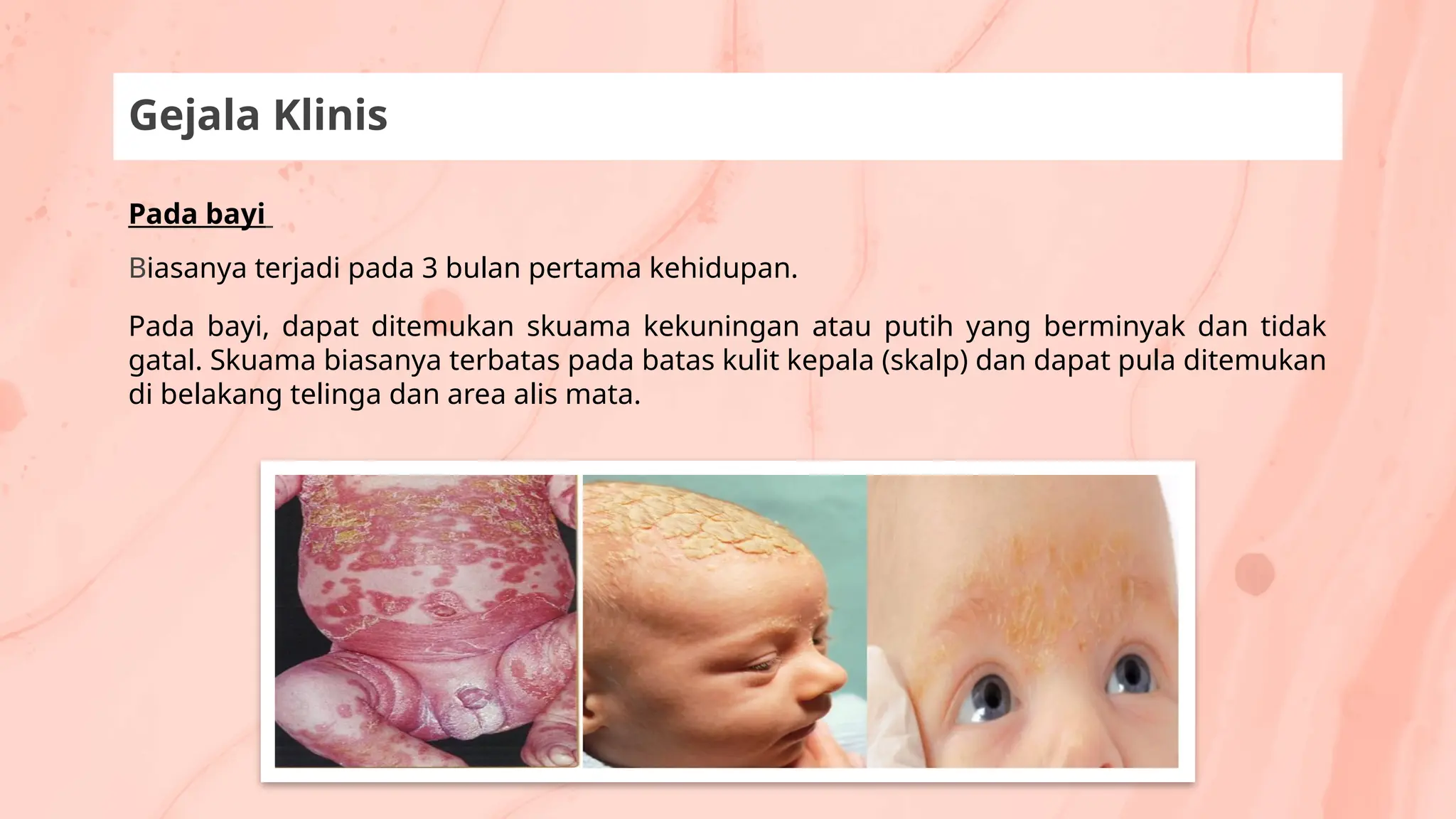 Pada bayi
Biasanya terjadi pada 3 bulan pertama kehidupan.
Pada bayi, dapat ditemukan skuama kekuningan atau putih yang berminyak dan tidak
gatal. Skuama biasanya terbatas pada batas kulit kepala (skalp) dan dapat pula ditemukan
di belakang telinga dan area alis mata.
Gejala Klinis
 