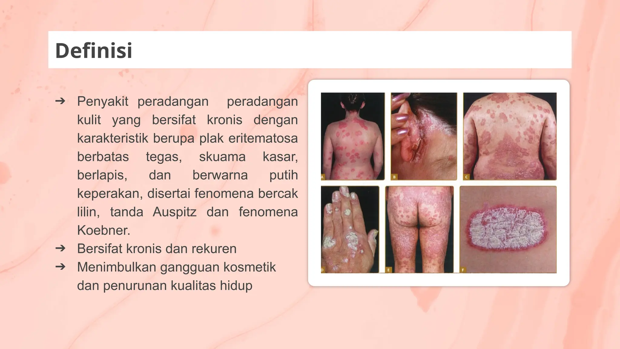 ➔ Penyakit peradangan peradangan
kulit yang bersifat kronis dengan
karakteristik berupa plak eritematosa
berbatas tegas, skuama kasar,
berlapis, dan berwarna putih
keperakan, disertai fenomena bercak
lilin, tanda Auspitz dan fenomena
Koebner.
➔ Bersifat kronis dan rekuren
➔ Menimbulkan gangguan kosmetik
dan penurunan kualitas hidup
Definisi
 