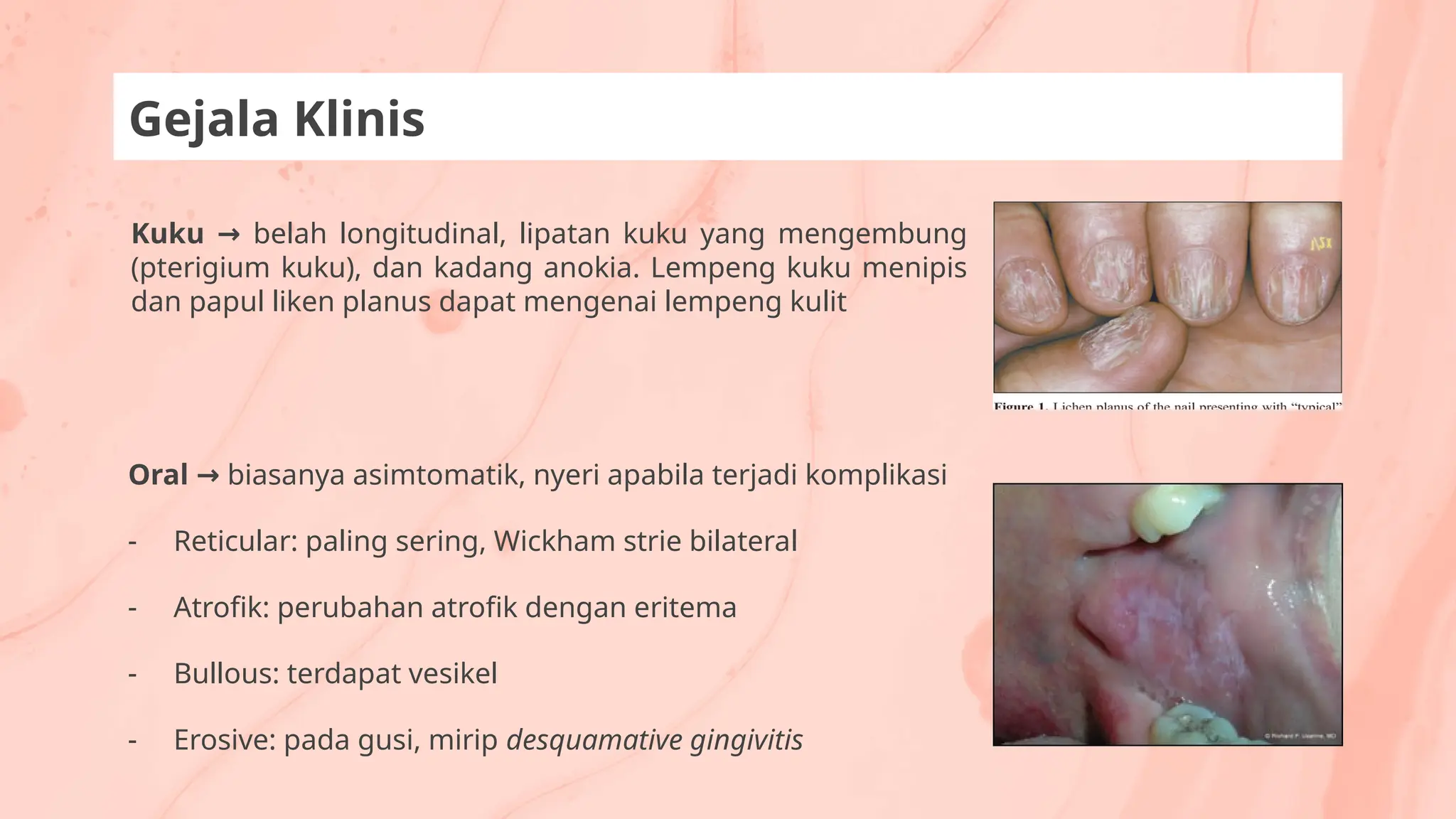 Kuku → belah longitudinal, lipatan kuku yang mengembung
(pterigium kuku), dan kadang anokia. Lempeng kuku menipis
dan papul liken planus dapat mengenai lempeng kulit
Gejala Klinis
Oral → biasanya asimtomatik, nyeri apabila terjadi komplikasi
- Reticular: paling sering, Wickham strie bilateral
- Atrofik: perubahan atrofik dengan eritema
- Bullous: terdapat vesikel
- Erosive: pada gusi, mirip desquamative gingivitis
 