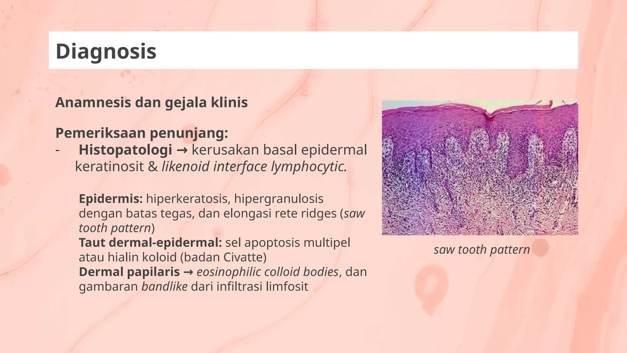 Anamnesis dan gejala klinis
Pemeriksaan penunjang:
- Histopatologi → kerusakan basal epidermal
keratinosit & likenoid interface lymphocytic.
Epidermis: hiperkeratosis, hipergranulosis
dengan batas tegas, dan elongasi rete ridges (saw
tooth pattern)
Taut dermal-epidermal: sel apoptosis multipel
atau hialin koloid (badan Civatte)
Dermal papilaris → eosinophilic colloid bodies, dan
gambaran bandlike dari infiltrasi limfosit
Diagnosis
saw tooth pattern
 