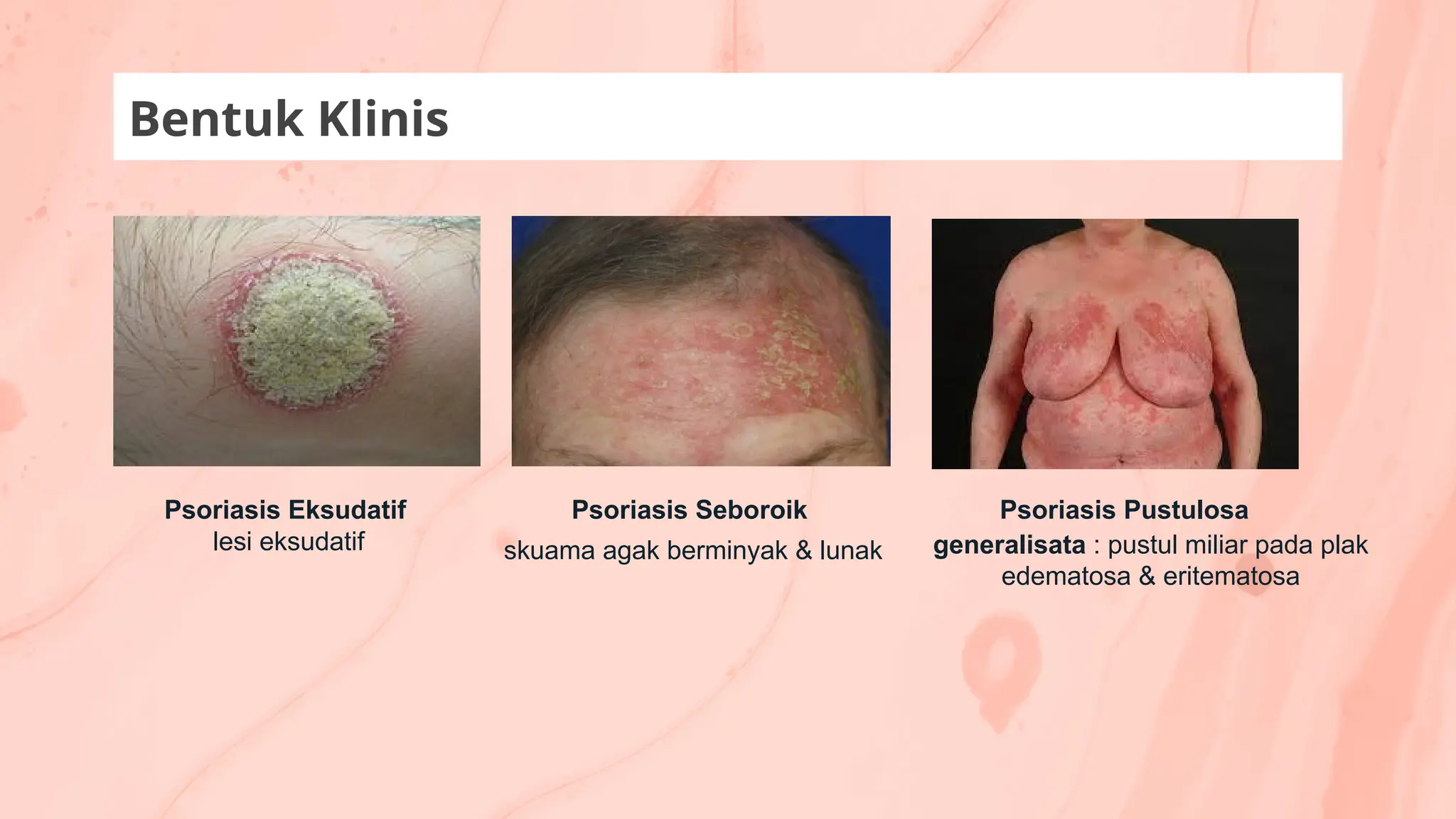 Bentuk Klinis
Psoriasis Seboroik
skuama agak berminyak & lunak
Psoriasis Eksudatif
lesi eksudatif
Psoriasis Pustulosa
generalisata : pustul miliar pada plak
edematosa & eritematosa
 